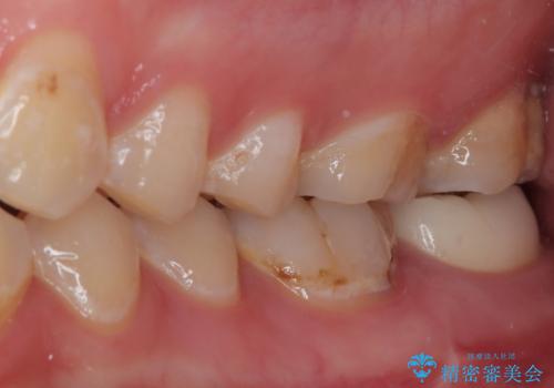 噛むと痛い 奥歯のむし歯治療の治療後