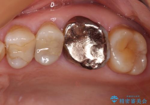 目立つ銀歯を白くしたい。オールセラミッククラウンによる補綴治療の治療前