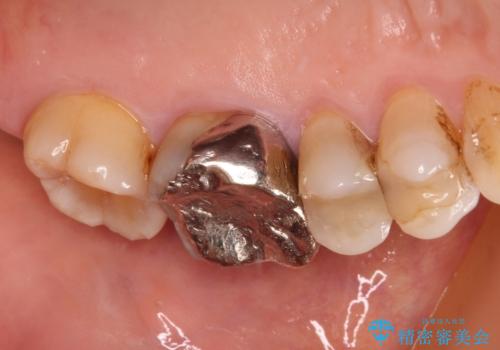 目立つ銀歯を白くしたい。オールセラミッククラウンによる補綴治療の治療前