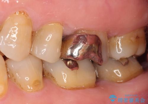 目立つ銀歯を白くしたい。オールセラミッククラウンによる補綴治療の治療前