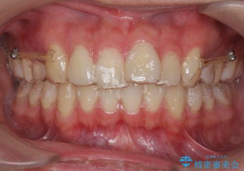 出っ歯の治療 インビザラインで抜歯矯正 親知らずを使用した矯正の治療中