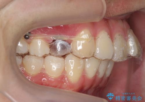 出っ歯の治療 インビザラインで抜歯矯正 親知らずを使用した矯正の治療中