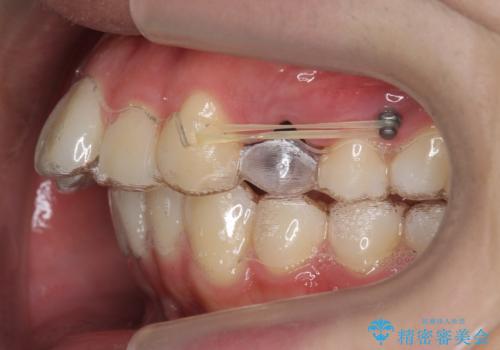 出っ歯の治療 インビザラインで抜歯矯正 親知らずを使用した矯正の治療中