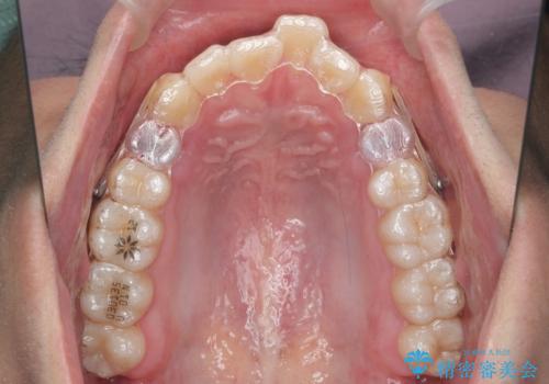 出っ歯の治療 インビザラインで抜歯矯正 親知らずを使用した矯正の治療中