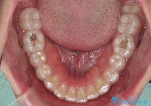 出っ歯の治療 インビザラインで抜歯矯正 親知らずを使用した矯正の治療中