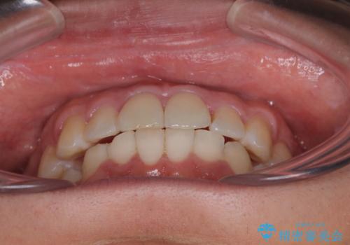 前方に捻れた前歯を治したい インビザライン矯正治療の治療後