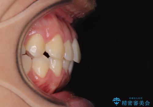 前方に捻れた前歯を治したい インビザライン矯正治療の治療後