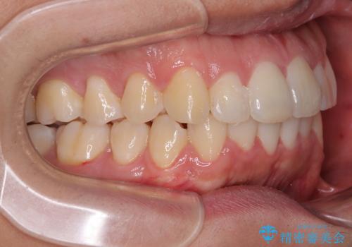 前方に捻れた前歯を治したい インビザライン矯正治療の治療後