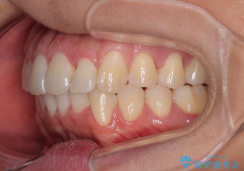 前方に捻れた前歯を治したい インビザライン矯正治療の治療後