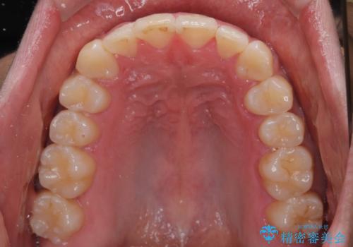 前方に捻れた前歯を治したい インビザライン矯正治療の治療後