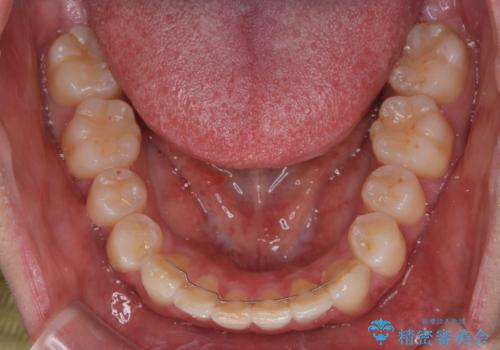 前方に捻れた前歯を治したい インビザライン矯正治療の治療後