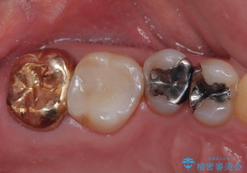 詰め物が欠けた ハイブリッドインレー修復の治療後