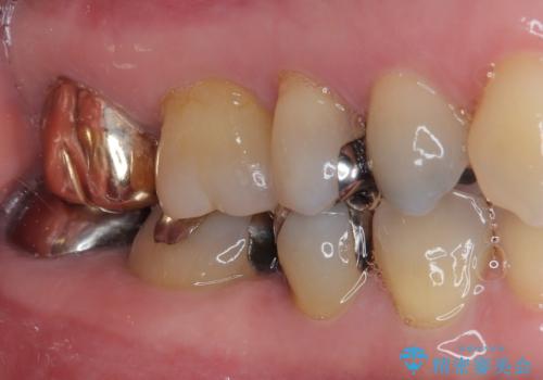 詰め物が欠けた ハイブリッドインレー修復の治療後