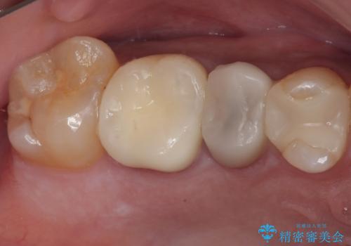 セラミックが欠けた オールセラミッククラウンの症例 治療後