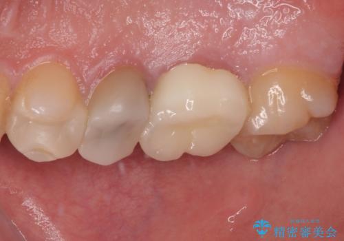 セラミックが欠けた オールセラミッククラウンの治療後
