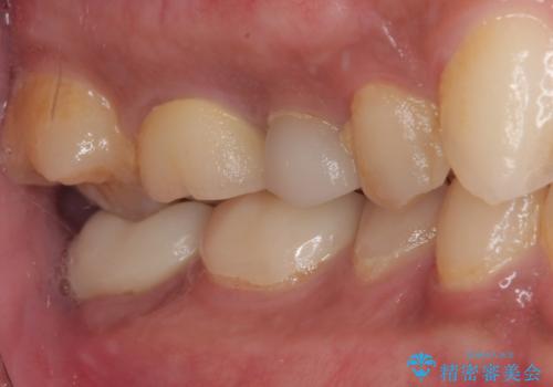 セラミックが欠けた オールセラミッククラウンの治療後
