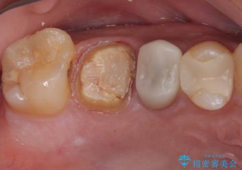 セラミックが欠けた オールセラミッククラウンの治療中