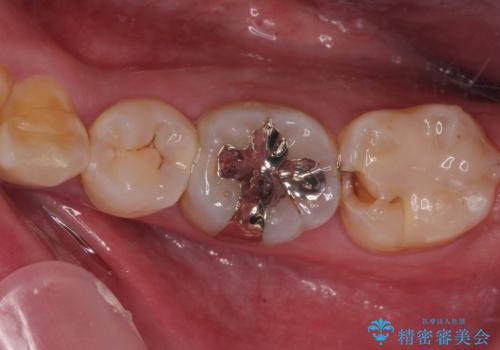 詰め物が欠けて虫歯になってる気がする セラミックインレー修復の治療前