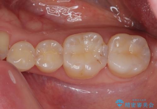 銀歯がとれたのでついでに他もやり替えたい セラミックインレー修復・セラミックアンレー修復の治療後