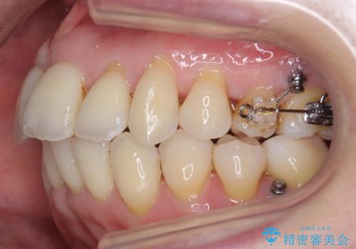 奥歯が倒れてしまっている 親知らずを利用した矯正の治療中