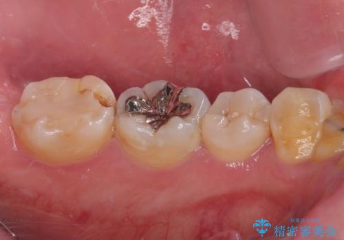 詰め物が欠けて虫歯になってる気がする セラミックインレー修復の治療前