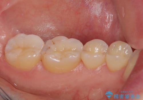 銀歯がとれたのでついでに他もやり替えたい セラミックインレー修復・セラミックアンレー修復の治療後