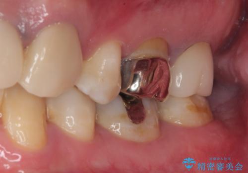 詰め物が欠けて虫歯になってる気がする セラミックインレー修復の治療前