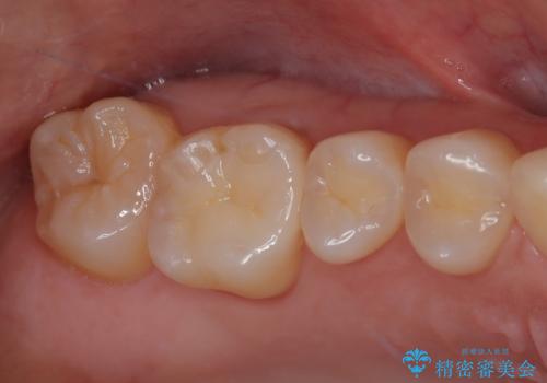 上の銀歯をやり替えたい セラミックインレー修復の治療後