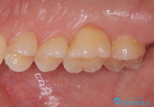 上の銀歯をやり替えたい セラミックインレー修復の治療後