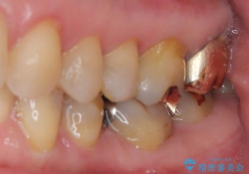 銀歯が取れた セラミックインレー修復の治療前