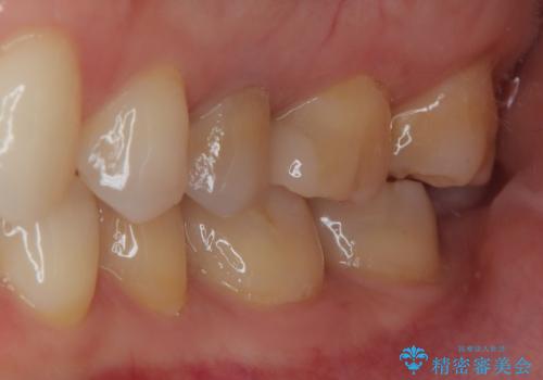 銀歯がとれたのでついでに他もやり替えたい セラミックインレー修復・セラミックアンレー修復の治療後