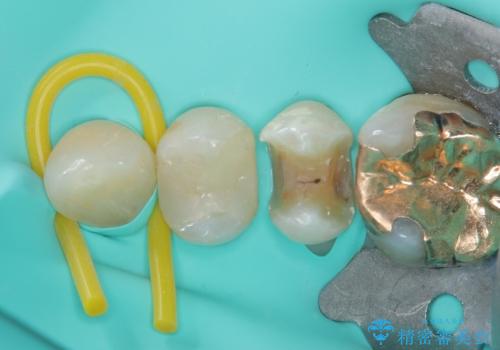 銀歯が取れた セラミックインレー修復の治療中