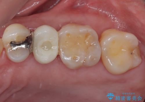 手術が怖くて抜いたままの奥歯に歯を 1DAYインプラント治療の症例 治療後