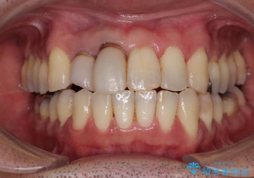 隠れている前歯 インビザライン矯正治療と前歯のセラミック治療の治療中