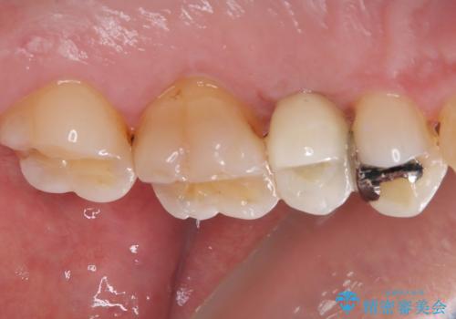 手術が怖くて抜いたままの奥歯に歯を 1DAYインプラント治療の治療後