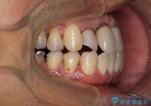 隠れている前歯 インビザライン矯正治療と前歯のセラミック治療の治療中