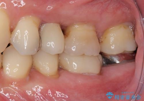 手術が怖くて抜いたままの奥歯に歯を 1DAYインプラント治療の治療後