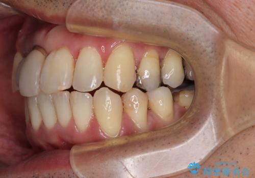 隠れている前歯 インビザライン矯正治療と前歯のセラミック治療の治療中