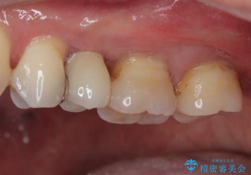 手術が怖くて抜いたままの奥歯に歯を 1DAYインプラント治療の治療後
