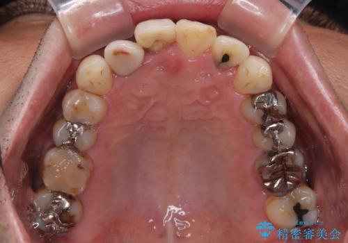 隠れている前歯 インビザライン矯正治療と前歯のセラミック治療の治療中