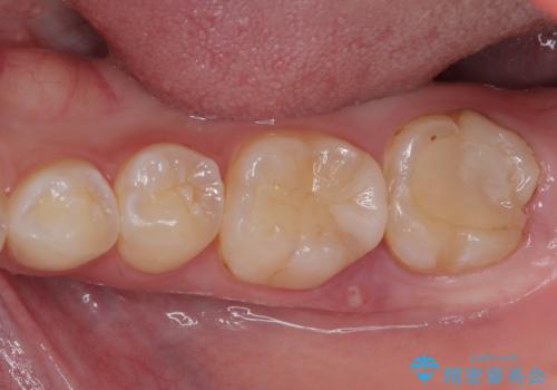 噛むと痛い 奥歯のむし歯治療の症例 治療前