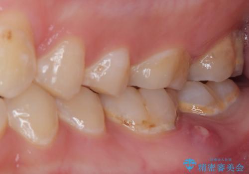 噛むと痛い 奥歯のむし歯治療の治療前