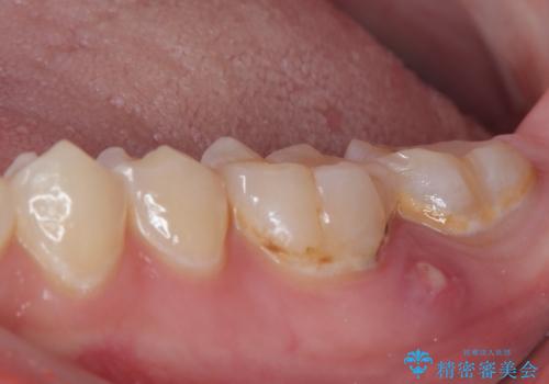 噛むと痛い 奥歯のむし歯治療の治療前