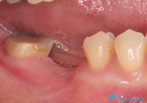 破折して抜歯が必要となった奥歯 オールセラミックブリッジ治療の治療前