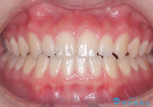 通院1回で輝く白い歯にの治療前