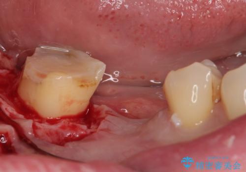 破折して抜歯が必要となった奥歯 オールセラミックブリッジ治療の治療中