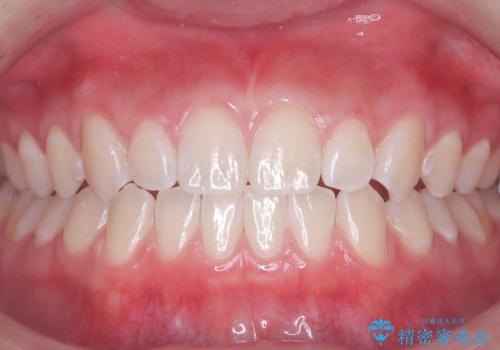 通院1回で輝く白い歯にの治療後