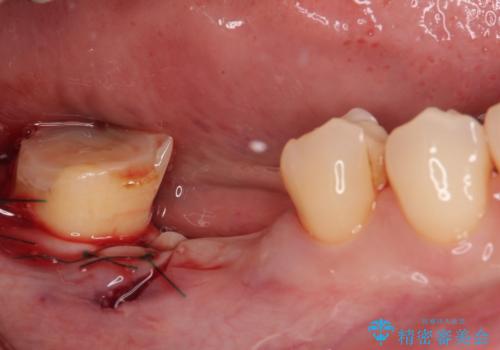 破折して抜歯が必要となった奥歯 オールセラミックブリッジ治療の治療後