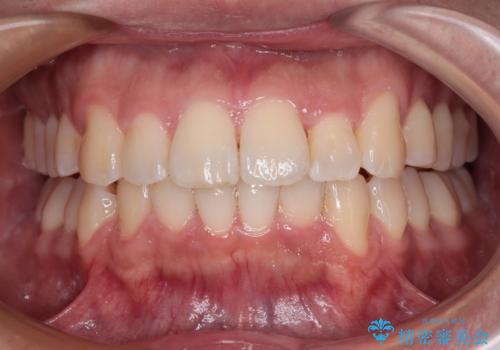 前方に捻れた前歯を治したい インビザライン矯正治療の治療中