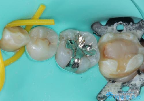 詰め物が欠けて虫歯になってる気がする セラミックインレー修復の治療中